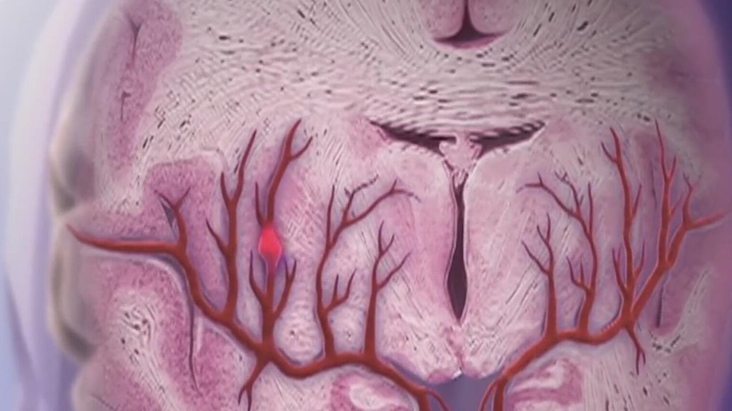 Knowing the signs of a stroke can save lives — Milton Community news